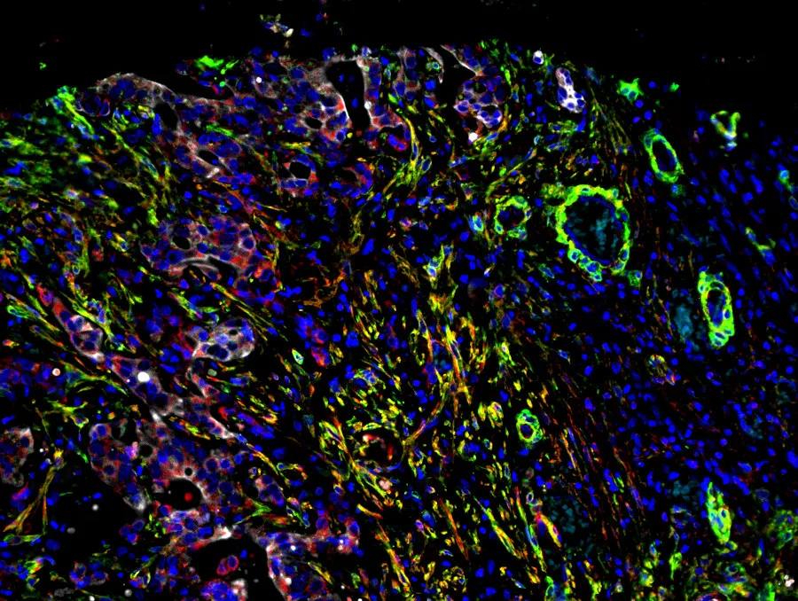 Human bile duct cancer containing tumour cells, cancer associated fibroblasts, and Fn14 receptors