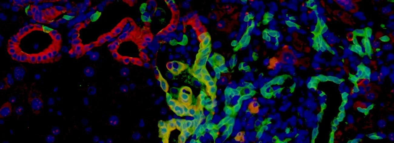 bile duct cancer in mice