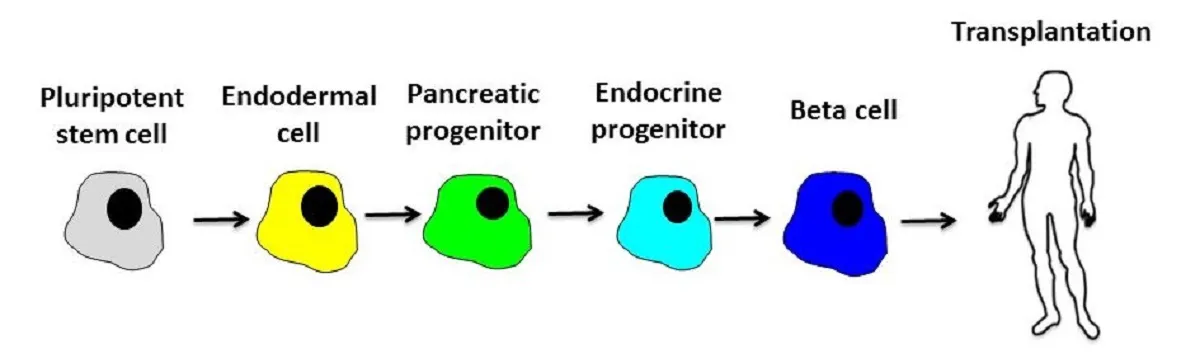 diabetes stem cell transplantation