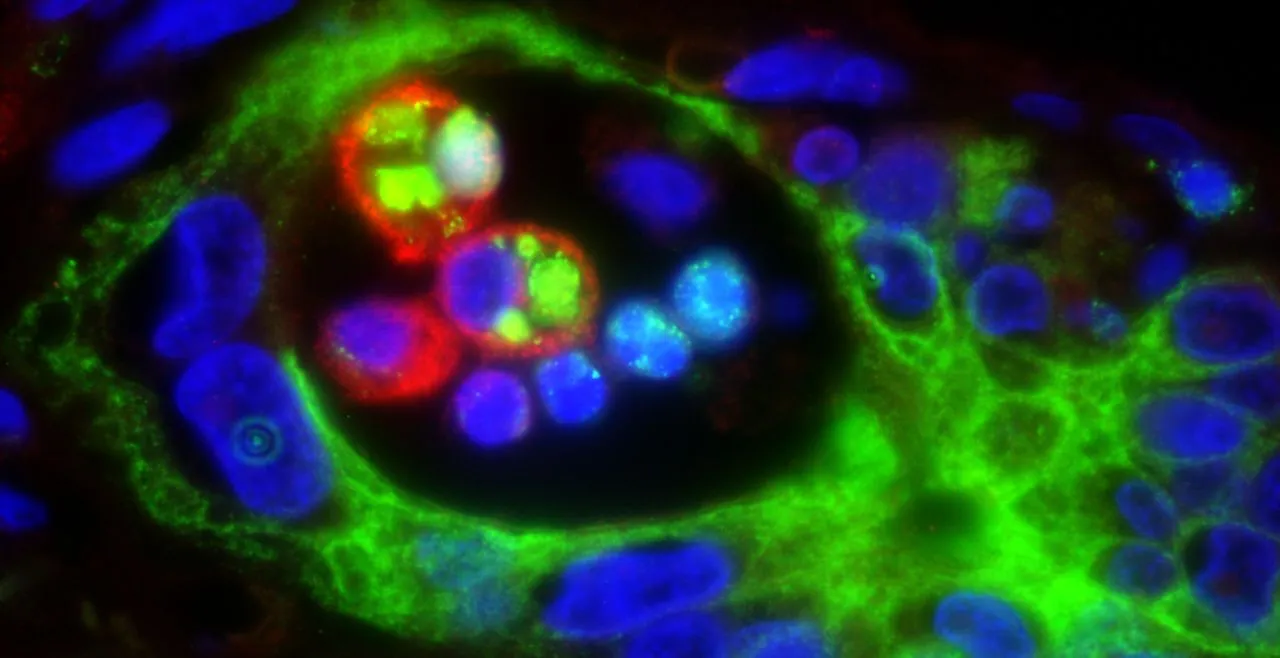 Human liver tissue showing Cholangiocarcinoma and macrophages