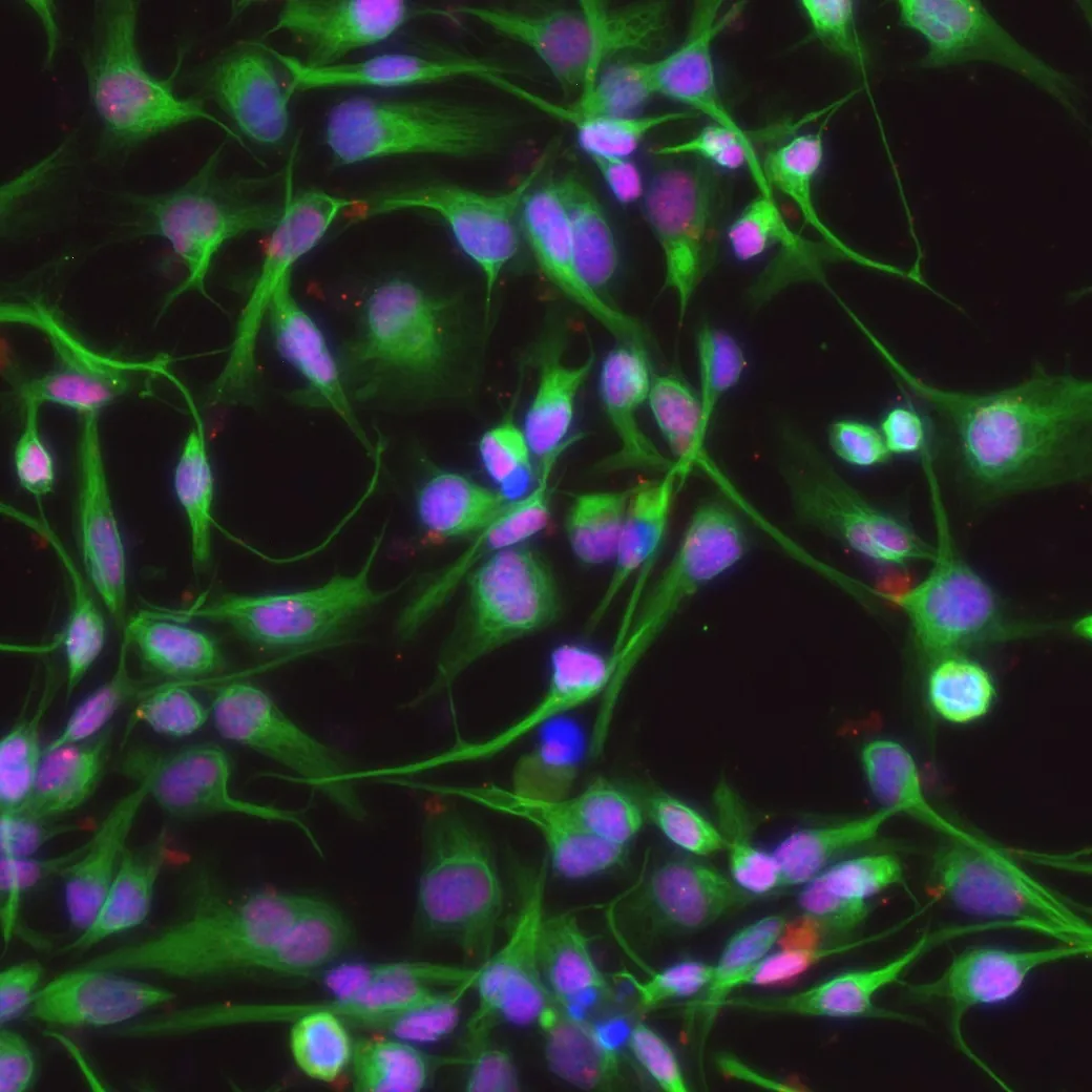 Cells isolated from a child with high grade glioma. 