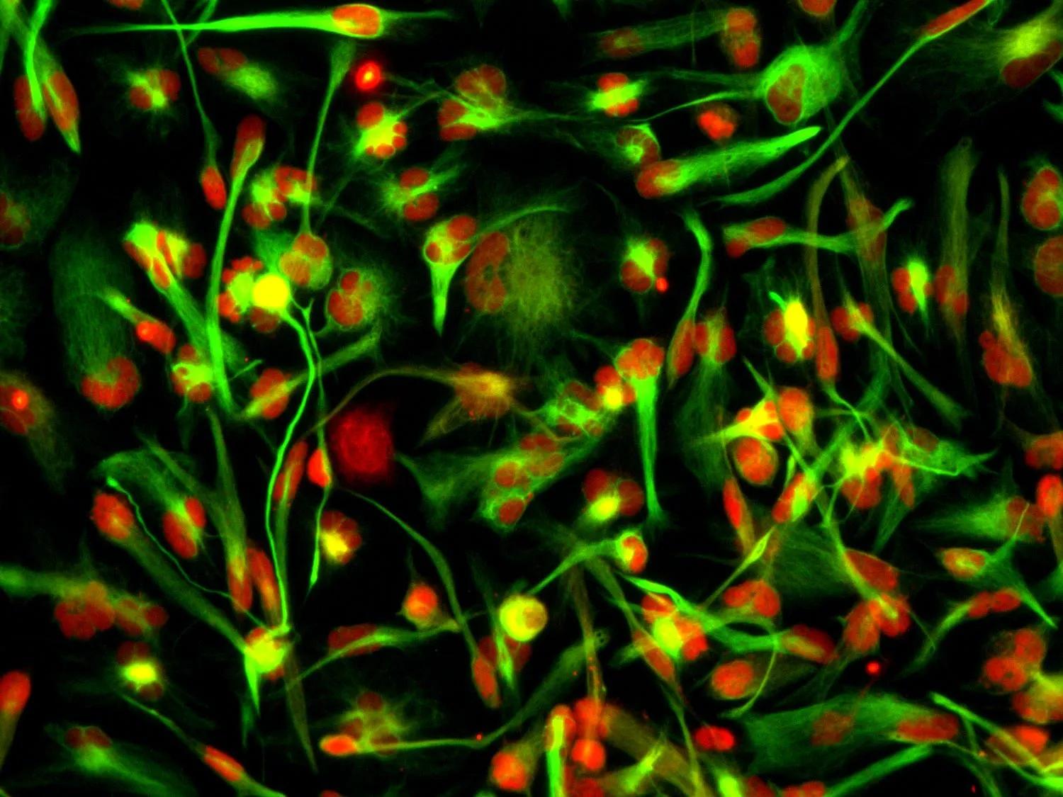 ‘An image of glioblastoma stem cells stained with markers SOX2 (red) and nestin (green).’