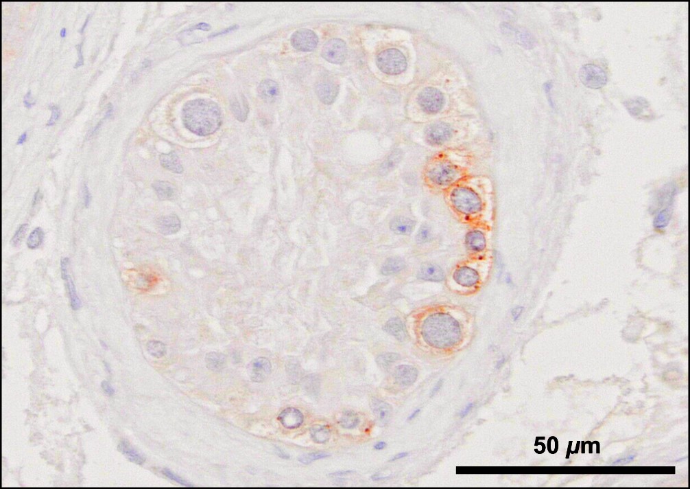 Cellular imaging. Jumping genes (brown stain) attacking germ cell DNA (blue stain) in a human testis biopsy