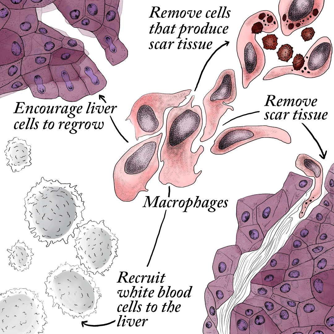 How macrophages help treat liver cirrhosis